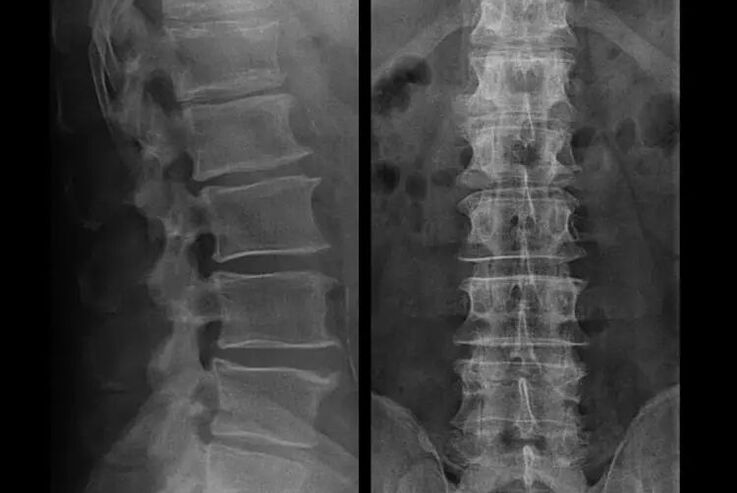 Röntgen-Osteochondrose