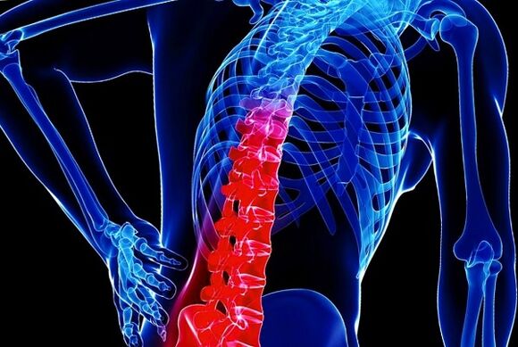 Die Gründe für die Entwicklung der torakalen Osteochondose