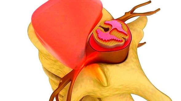 Osteochondrose der Brustwirbelsäule Die Essenz der Krankheit