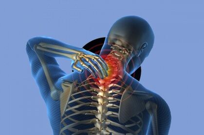 Nackenschmerzen mit Osteochondose
